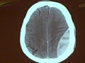 Epidural Hematoma