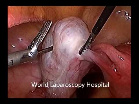 how to cure ohss