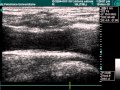 Common Femoral Vein Valve In Doppler Examination Common Femoral Vein Valve In Doppler Examination