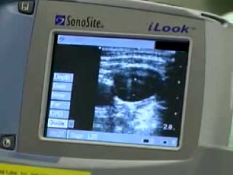 how to locate ijv