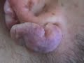 A Real Keloid in Body Piercing A Real Keloid in Body Piercing