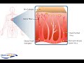 Shingles Pathophysiology