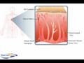 Shingles Pathophysiology
