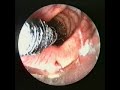 JET Beatmung STENT Ultraflex Entfaltung INVIVO