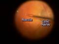 Macular Pucker 3