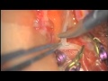 Morcos Webinar Video Case 2 Insitu anterior temporal artery Frontal M2 bypass, thrombectomy, clip reconstruction MCA aneurysm
