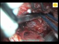 Neurosurgery Video Tentorial Meningioma