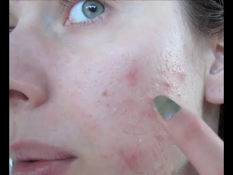 Acne Update! Skin Update! Journal + Face Diary + Dairy Free For Acne