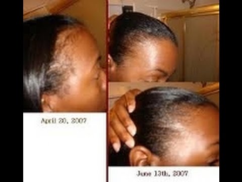 how to apply jbco to scalp