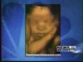 3D Baby Ultrasound