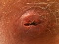 Pimple pop part 6 after