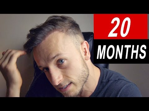 20 Months after FUE Hair Transplant in Istanbul,Turkey_Best videos: Silicone