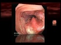 Colorectal Cancer