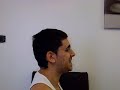 SM.J+10. Chirurgie Bimaxillaire/Jaw surgery Part.3