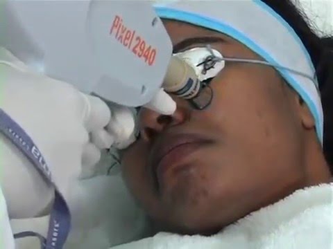 how to treat pimple scars