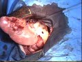 Back flow for bronchial art origin identification