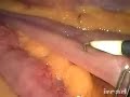 Jejuno-Jenunostomy in Laparoscopic Gastric bypass
