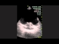 Bladder Diverticulum