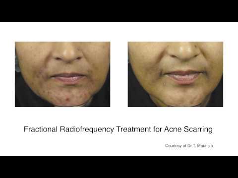 how to treat acne uk