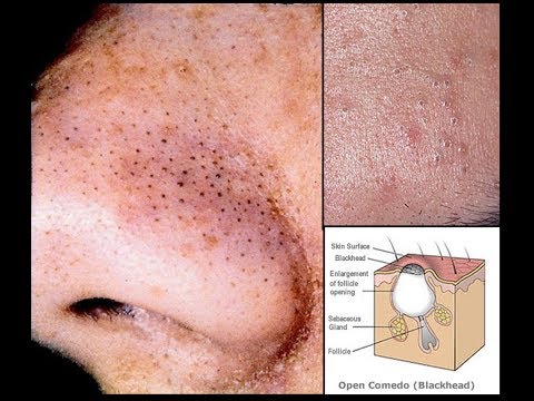 how to get rid of p acne