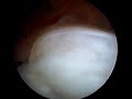 Large Rotator Cuff Tear Reduction