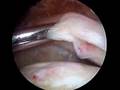 Large Rotator Cuff Tear Reduction