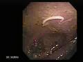 Worm in Small Intestine