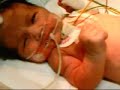 convulsion neonatal (Dr Ernesto Velasquez)