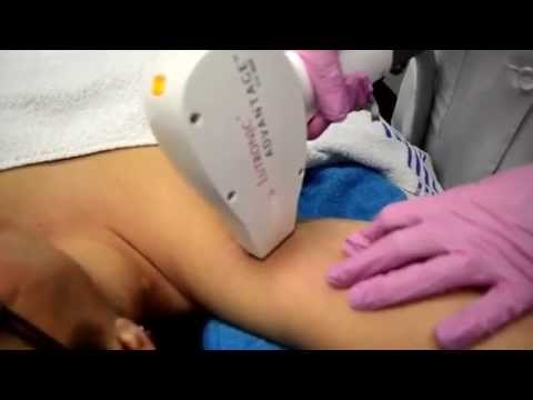 how to treat ipl laser burns