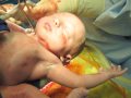 Prevent Cesarean Surgery
