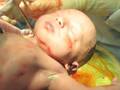 Prevent Cesarean Surgery