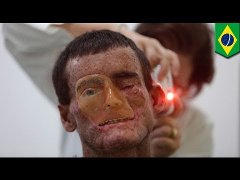 how to recover epidermis