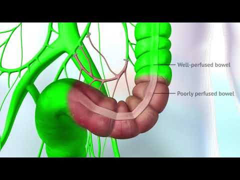 3D Animation Visualization of a Colectomy using ICG