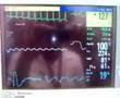VT Cardioversion