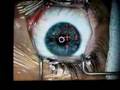 Lasik laser operation