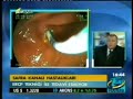 Safra yolu ve pankreas kanserlerinde neden ERCP yap?l?yor? Safra yolu ve pankreas kanserlerinde neden ERCP yap?l?yor?