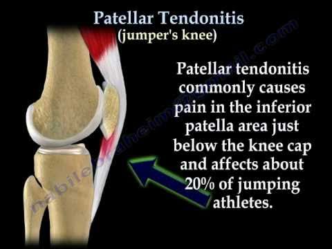 how to relieve jumper's knee pain