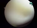 Rodilla Derecha de un Trotador (Parte I)