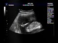 Ultrasonografia de Anna Beatriz com 18 semanas Ultrasonografia de Anna Beatriz com 18 semanas