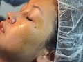 Tino Lerma - Milia Extraction Tino Lerma - Milia Extraction
