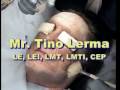 Tino Lerma - Milia Extraction