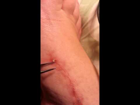 how to dissolve stitches