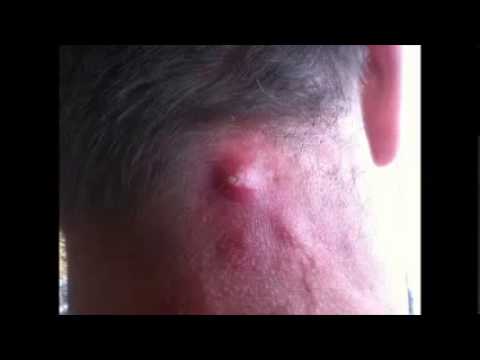 how to treat popped pimple