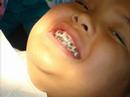 Braces
