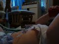 Pediatric gtube change