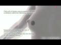 videos de MammaPrint Breast Cancer Test Process Animation