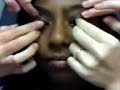 cross eye