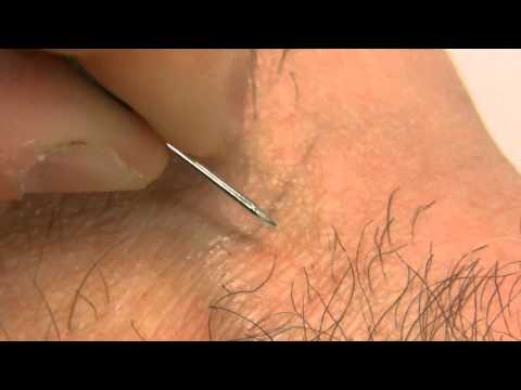 how to draw out an ingrown hair