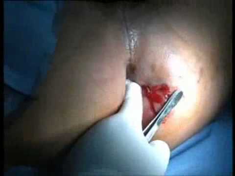 PERIANAL ABSCESS - 2nd Stage of high perianal fistula.