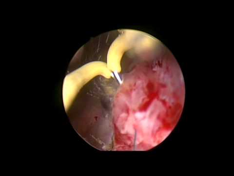 how to dissolve sutures faster